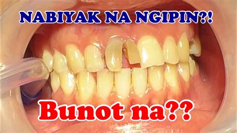 bunot ng ngipin in english translation